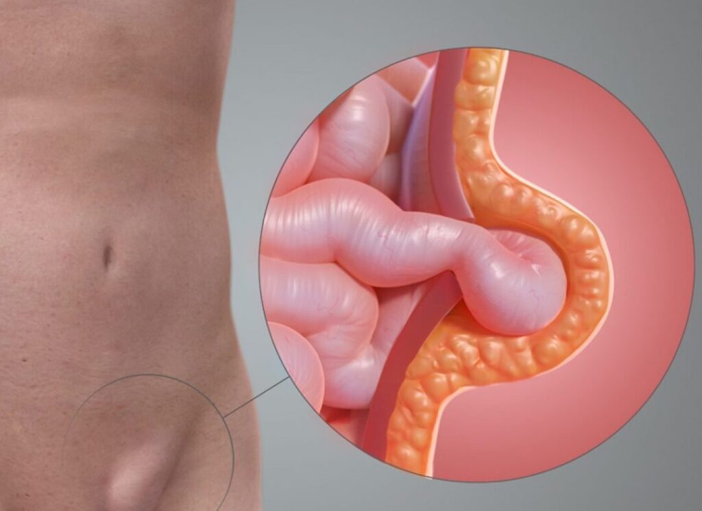 Comprendre l&rsquo;hernie inguinale testiculaire en images : causes, symptômes et traitements