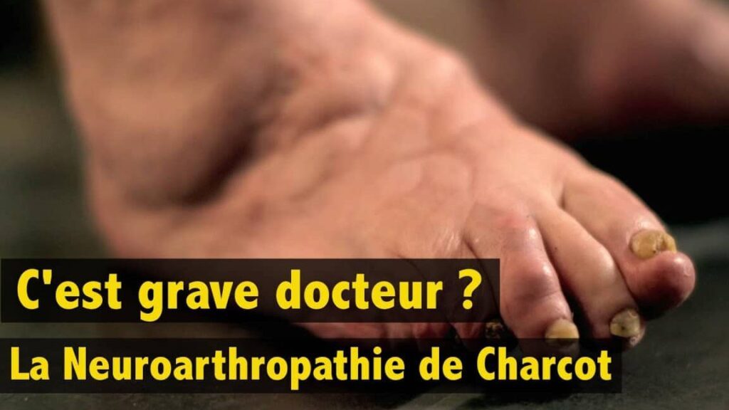 Comprendre la maladie de Charcot au niveau du pied : symptômes, traitement et prise en charge