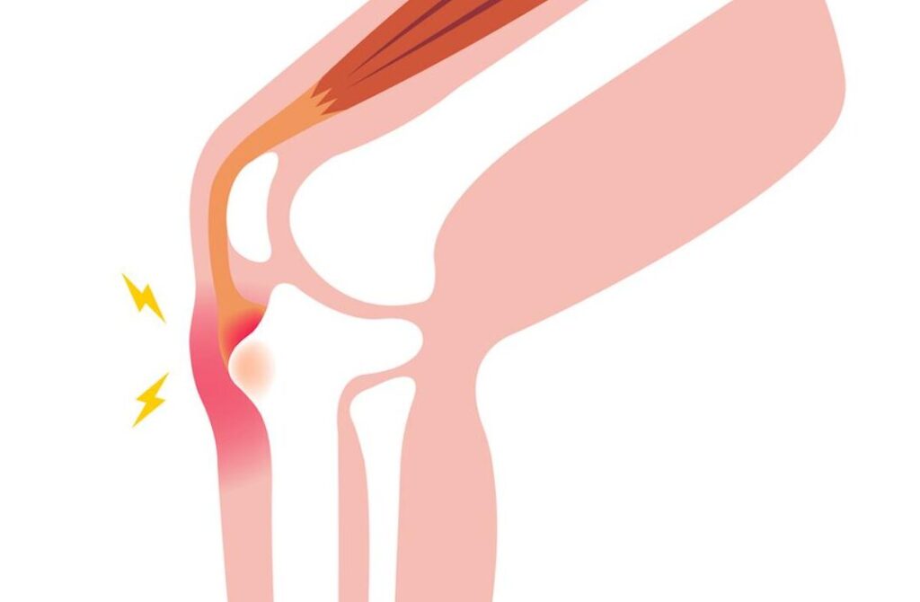 Osgood-Schlatter chez l’adulte : comprendre et gérer la douleur chronique