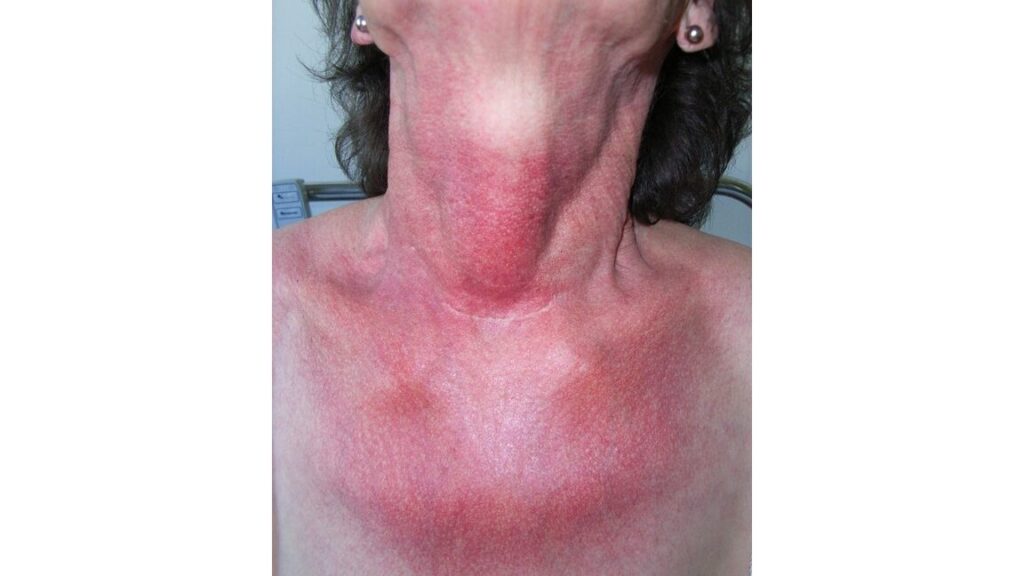 Pityriasis rosé de Gibert après une infection COVID-19 : coïncidence ou conséquence ?