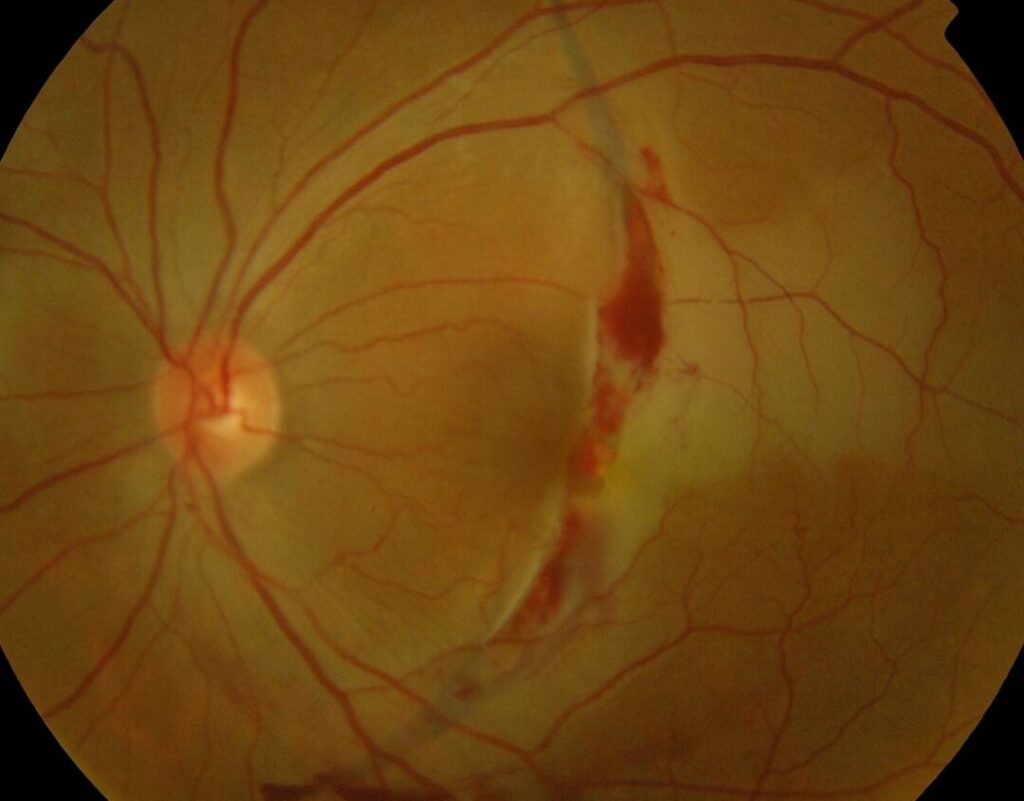 Comprendre le rôle du nerf crânien 4 dans la mobilité oculaire