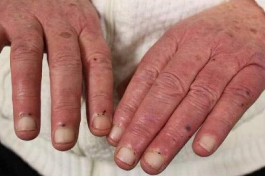 Comprendre l’endocardite de Janeway : symptômes, diagnostic et traitement