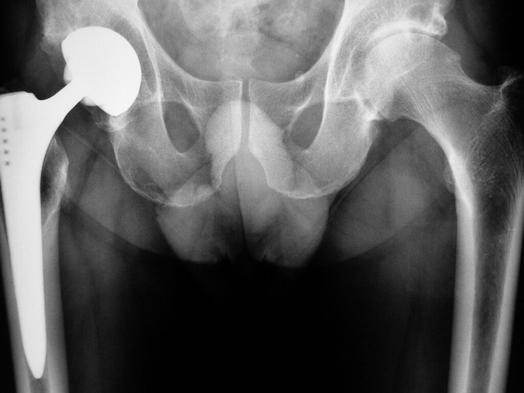 Sclérose sous-chondrale : comprendre les causes et les traitements efficaces