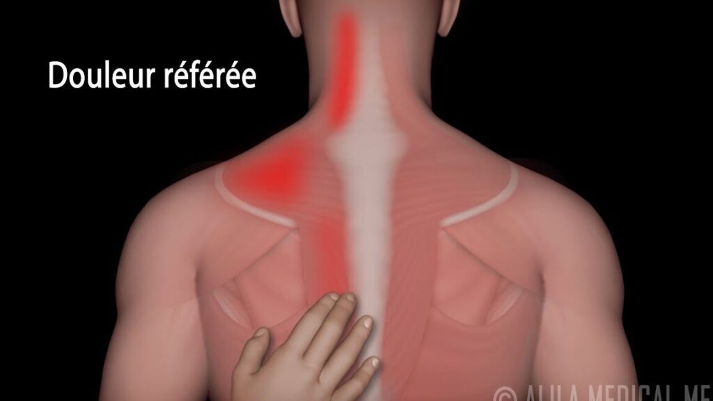 Combien de temps dure le syndrome myofascial et comment le soulager ?