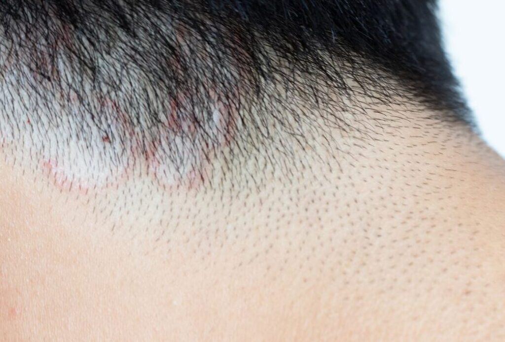 Comment traiter efficacement le pityriasis lichénoïde ?