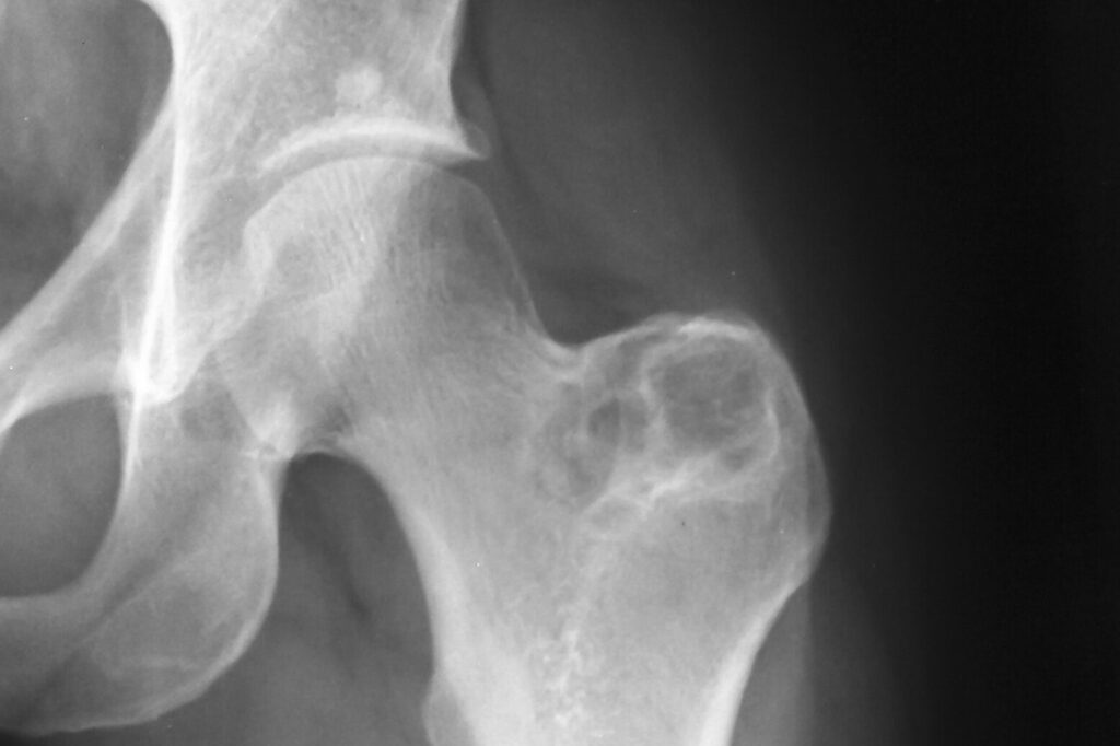 Fracture de hanche non opérée : quels sont les risques et alternatives ?