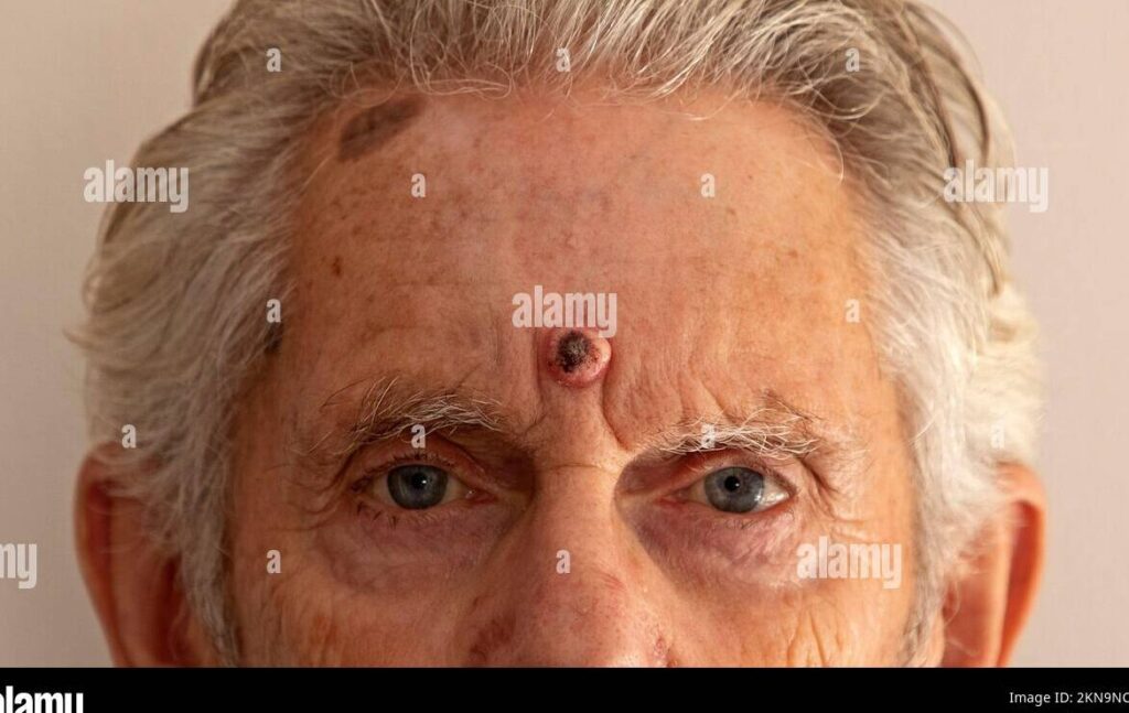 Kératoacanthome du visage : comment le reconnaître et le traiter ?
