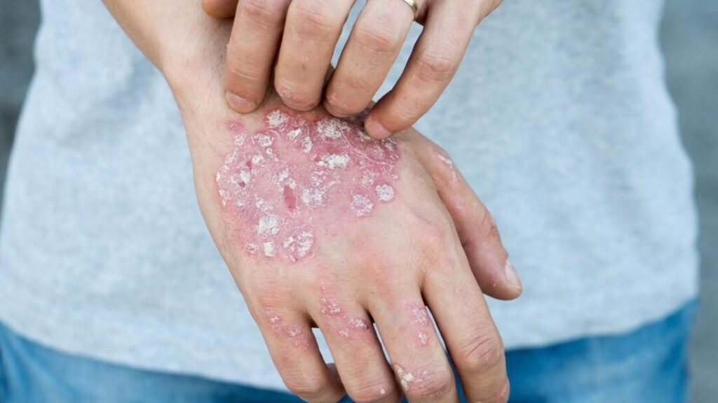 Psoriasis érythrodermique : quelles images et quelle réalité ?