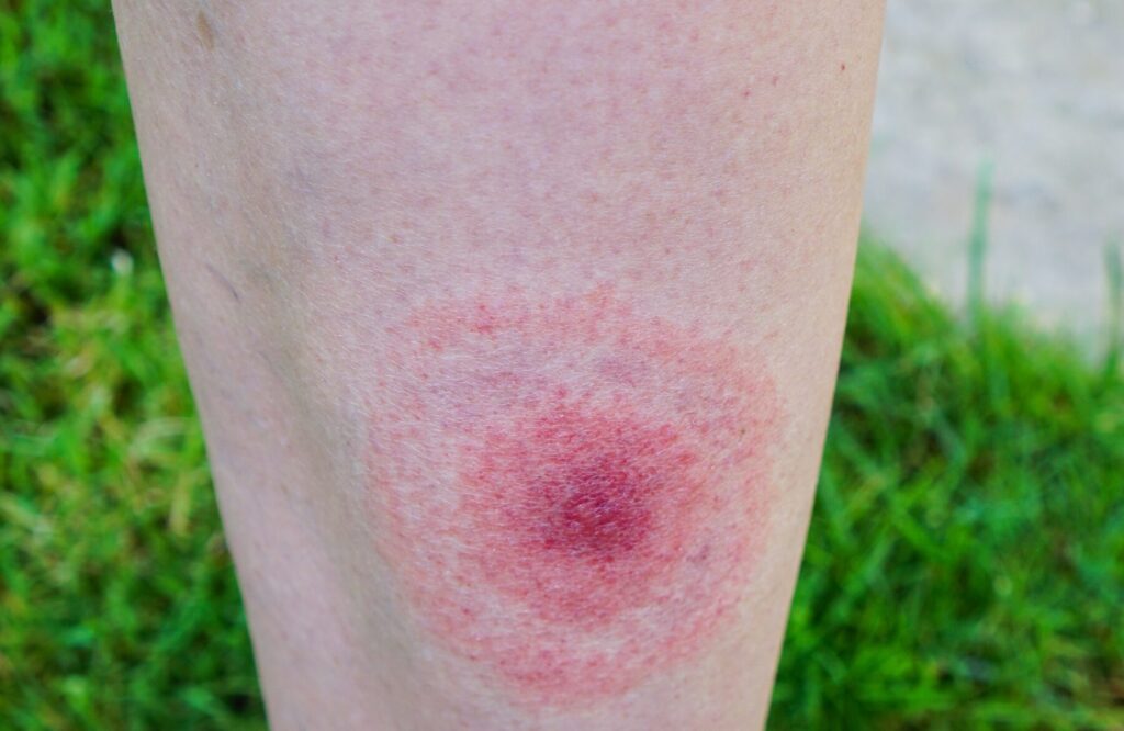 Reconnaître et comprendre la dermatose neutrophilique en images