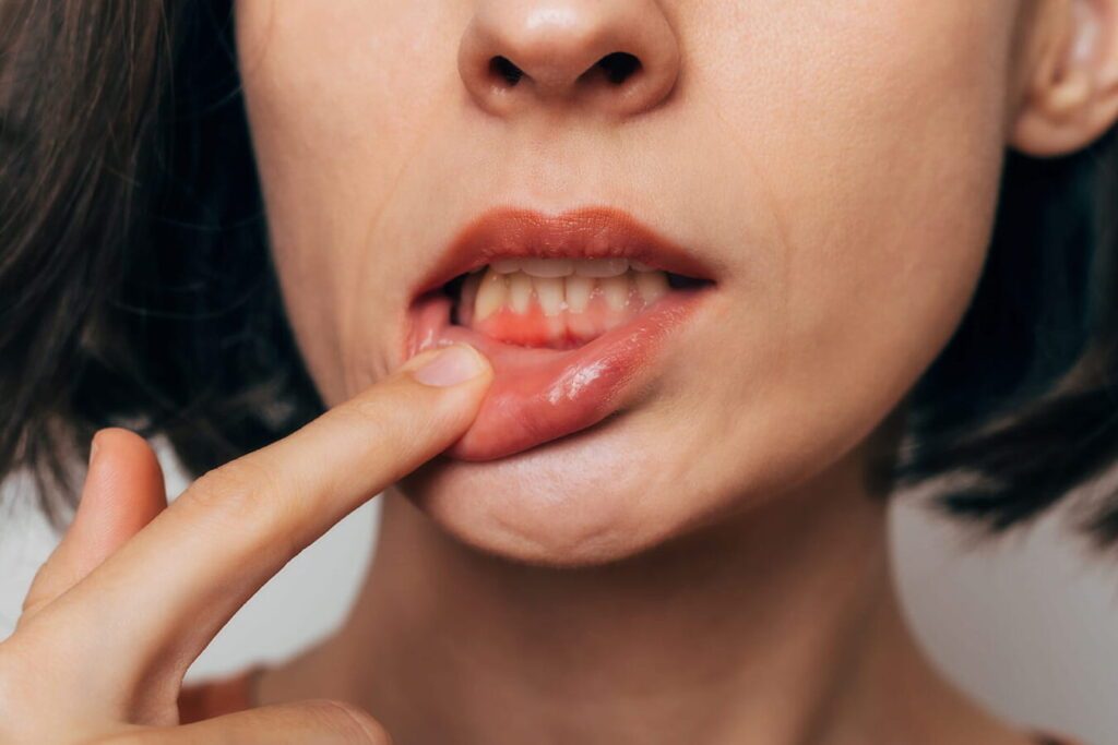 Comment traiter la gingivite ulcéronécrotique efficacement ?