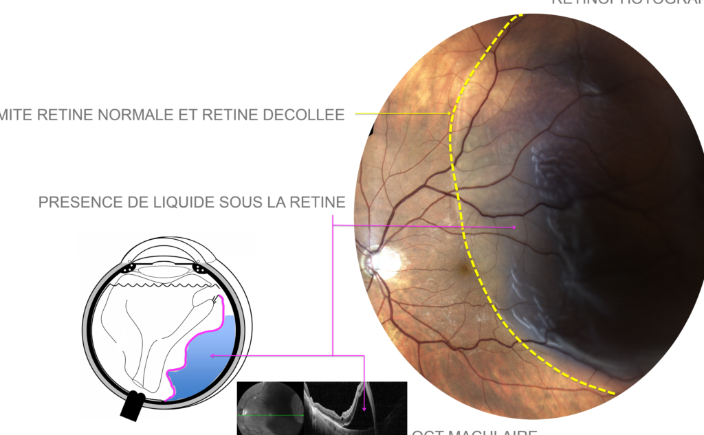 Comment reconnaître et traiter un décollement de rétine rhématogène ?