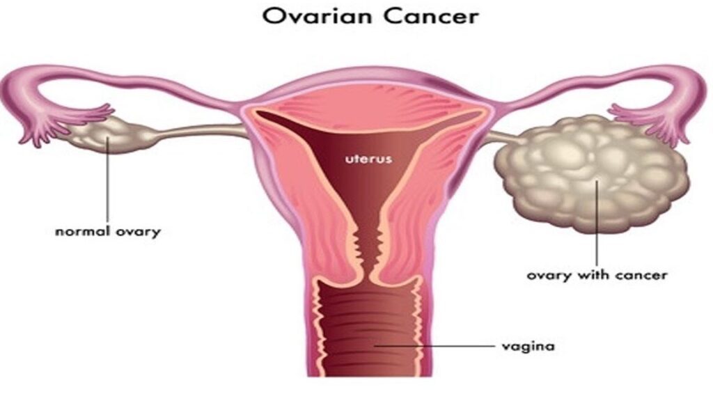 Comment reconnaître les symptômes du cancer de l&rsquo;ovaire ?