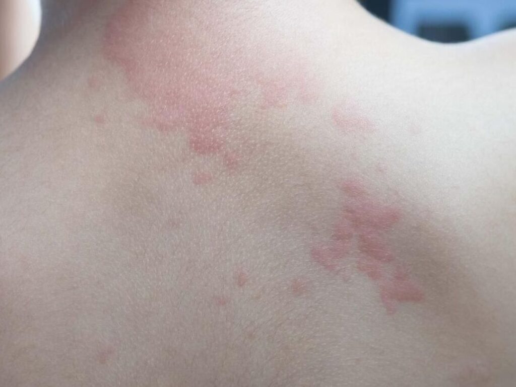 Comment gérer au quotidien une allergie chronique ?