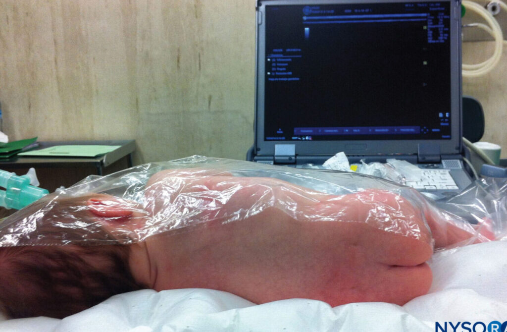Hypnovel et morphine : quels sont les effets secondaires courants ?