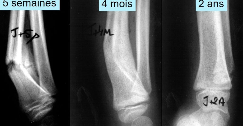Quelle est l&rsquo;importance du cartilage de croissance en radiologie ?