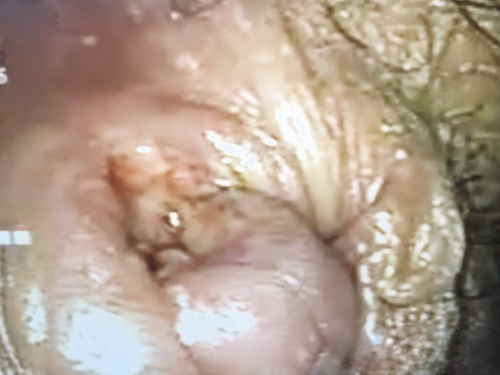 Utilisation de l’anuscope pour le diagnostic et le traitement des hémorroïdes