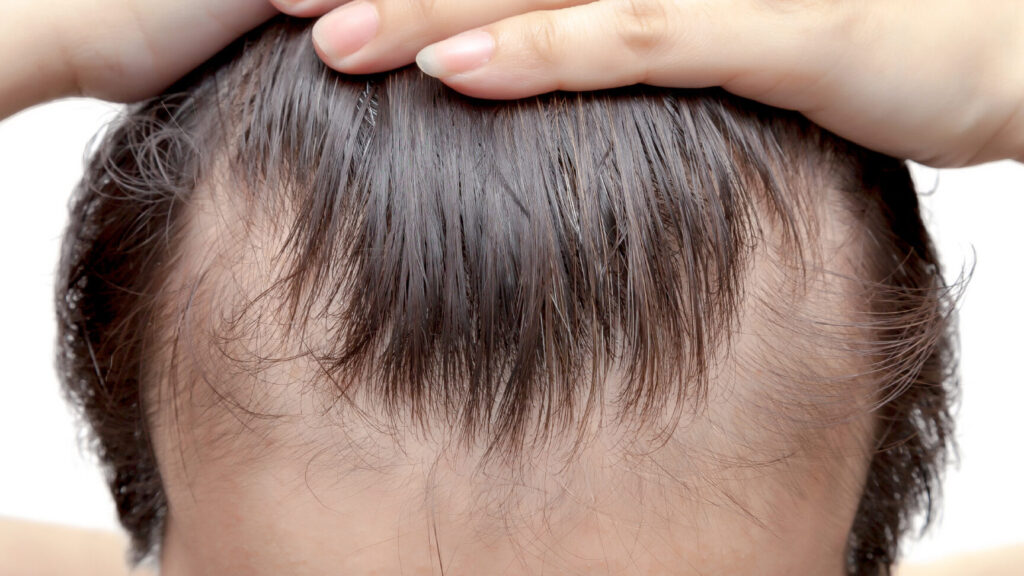 Absence de cheveux : causes et solutions possibles