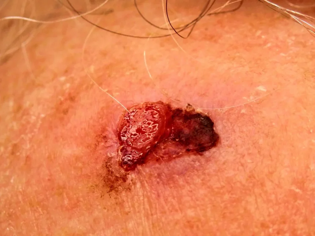 Carcinome de l’oreille : reconnaître les signes à partir de photos