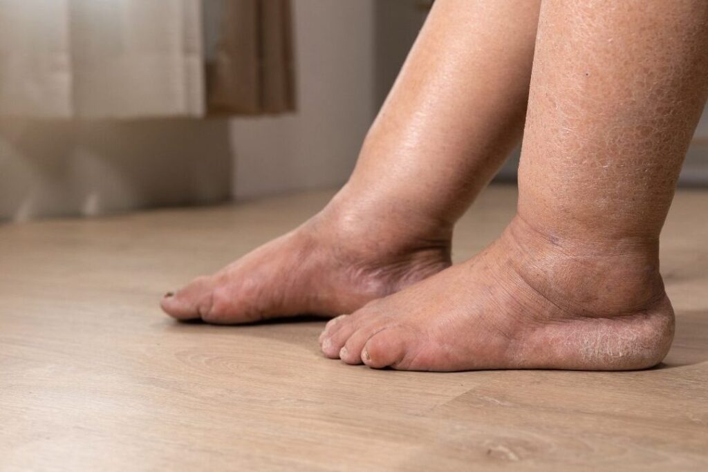 Comment la polyarthrite rhumatoïde affecte-t-elle vos pieds et quelles sont les solutions ?