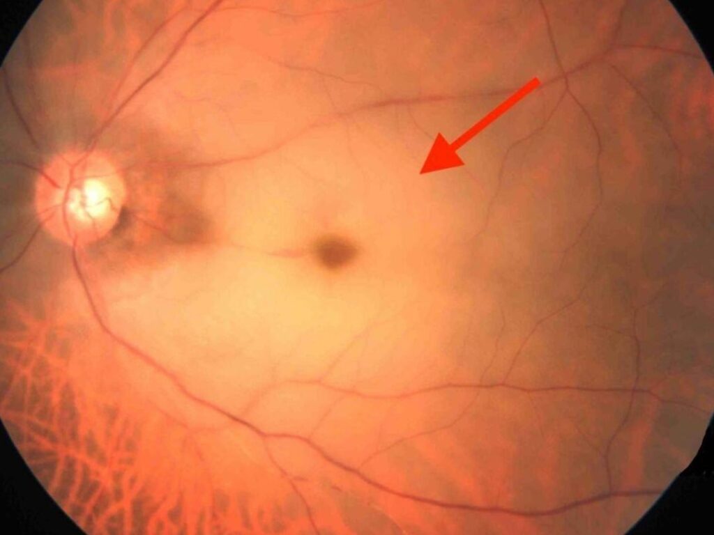 Comprendre l’occlusion artérielle et ses symptômes