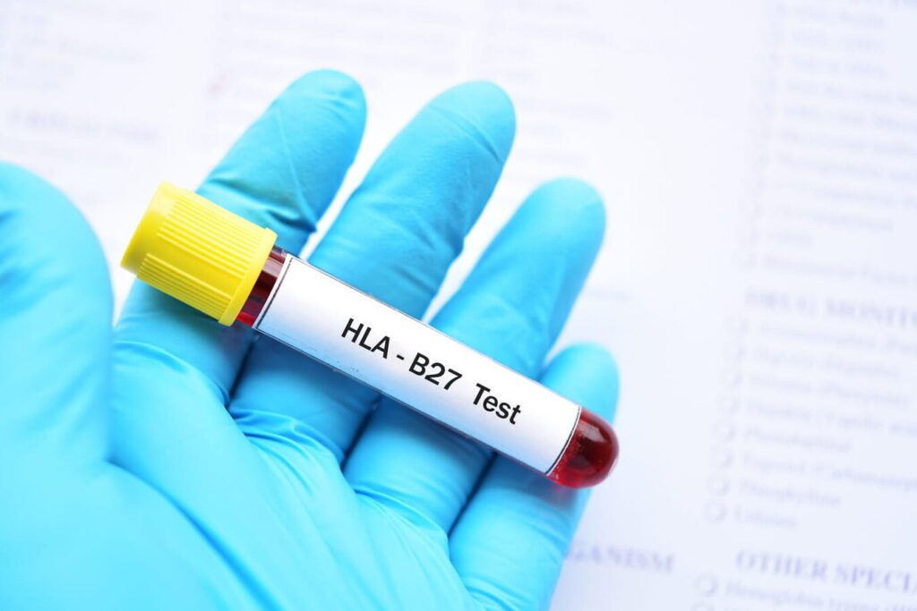 hla dr : l&rsquo;importance des antigènes dans les maladies auto-immunes expliquée