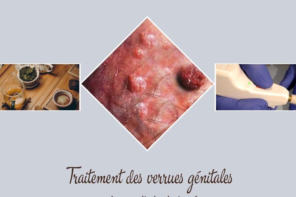 Molluscum contagiosum sur le pénis : comment le traiter efficacement ?