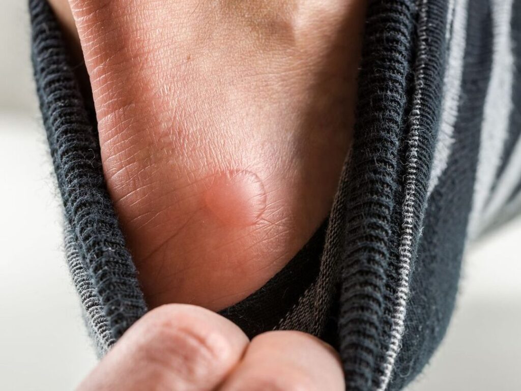 Phlyctène sur la jambe et œdème : que faut-il savoir ?