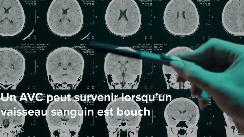 Reconnaître les signes de localisation d&rsquo;un AVC : pourquoi est-ce crucial ?