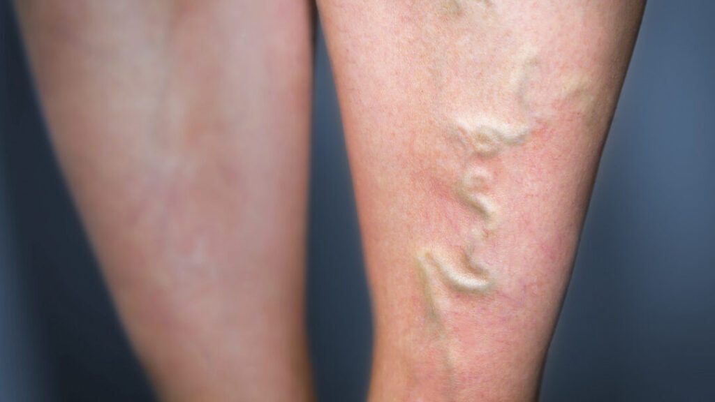 Combien de temps dure une thrombose veineuse et comment la gérer efficacement ?