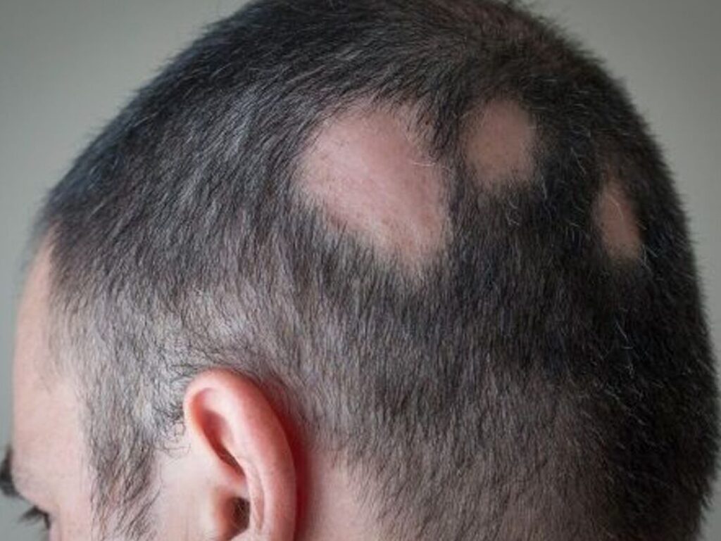Comment reconnaître et traiter la teigne microsporique chez l&rsquo;homme ?