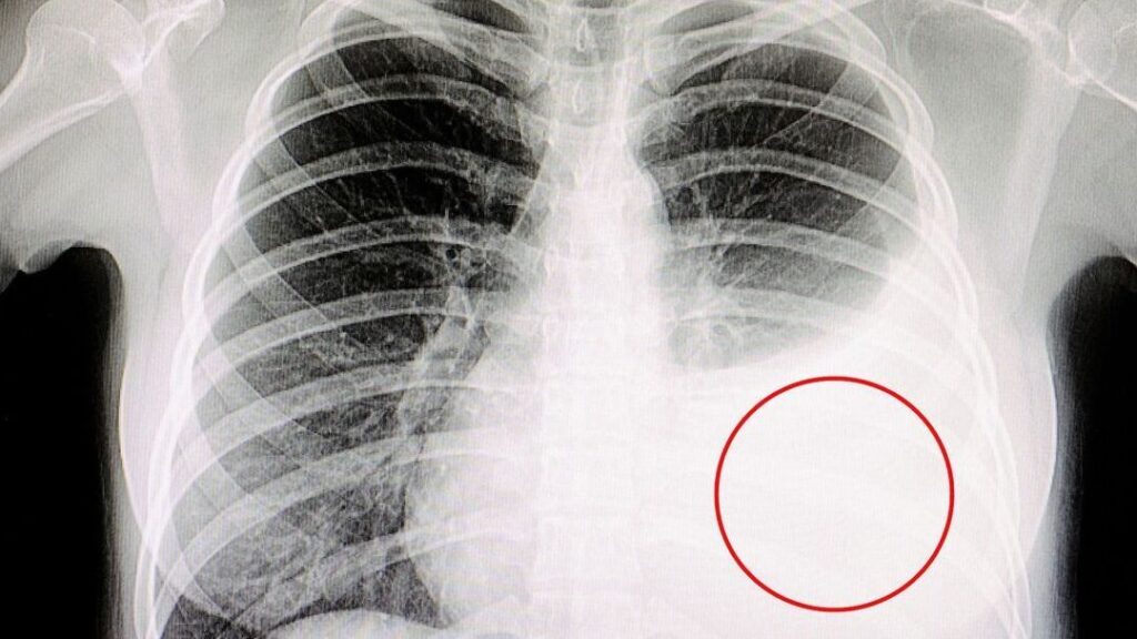 Émoussement pleural : quelle est l’importance de ce signe radiologique ?