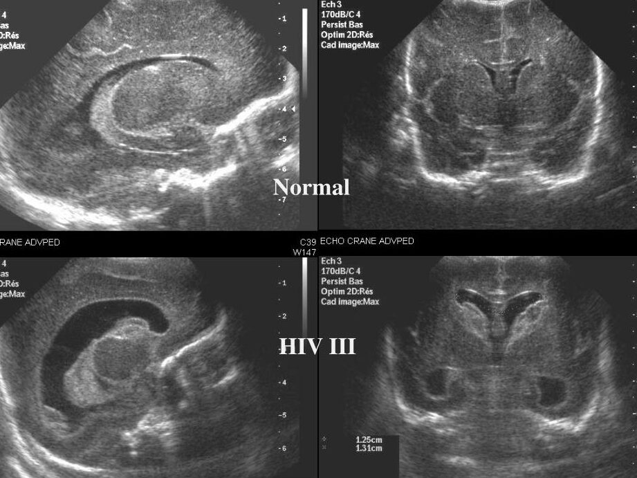 Porencéphalie et développement neurologique : ce que les parents doivent savoir