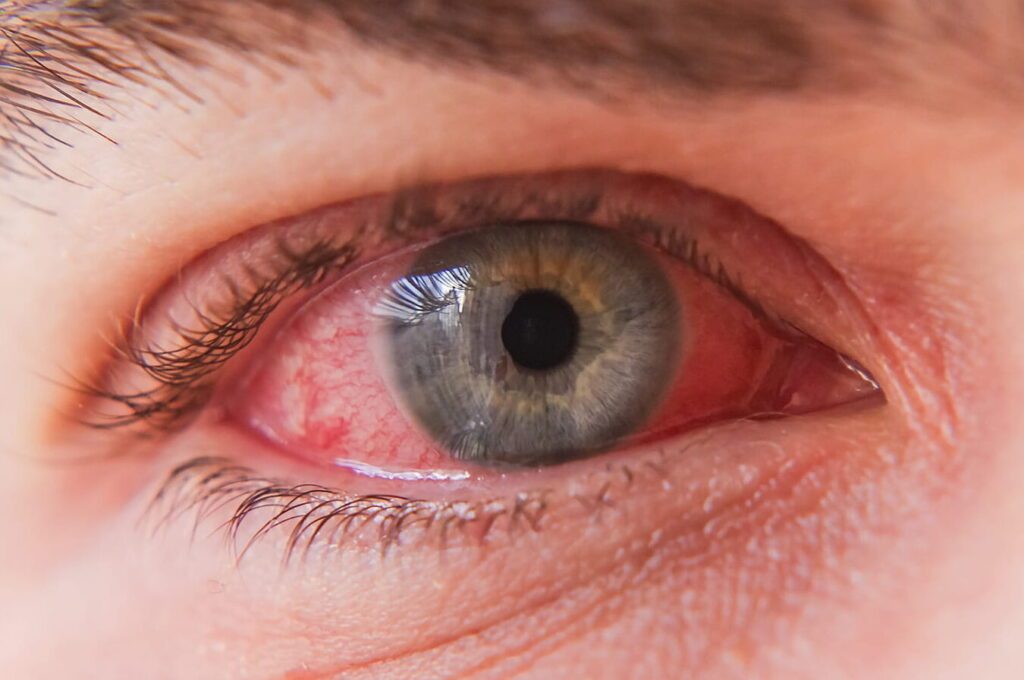 Yeux rouges et foie : y a-t-il un lien?