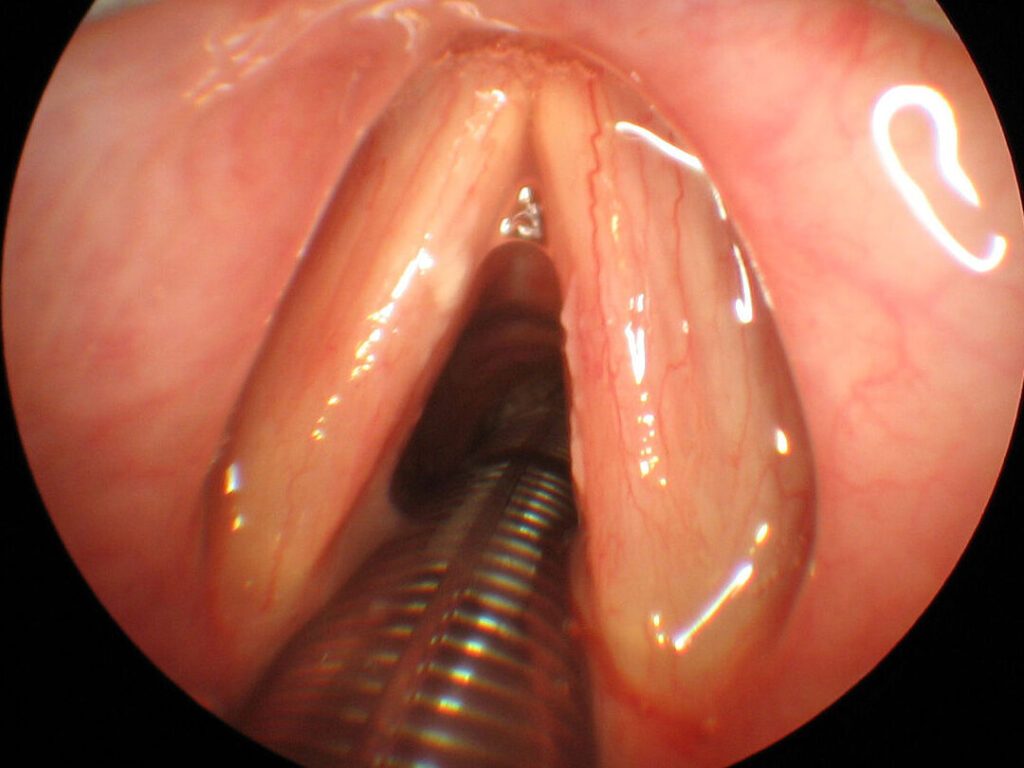 Qu’est-ce que l’intubation endotrachéale et quand est-elle nécessaire ?
