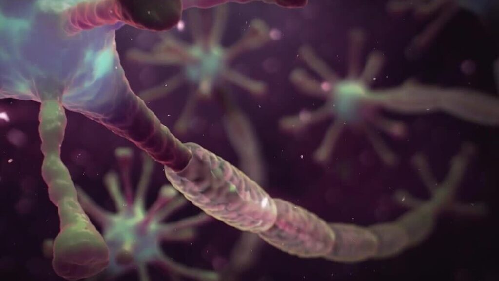 Syndrome de Guillain-Barré et sclérose en plaques : quelle relation et comment les distinguer ?