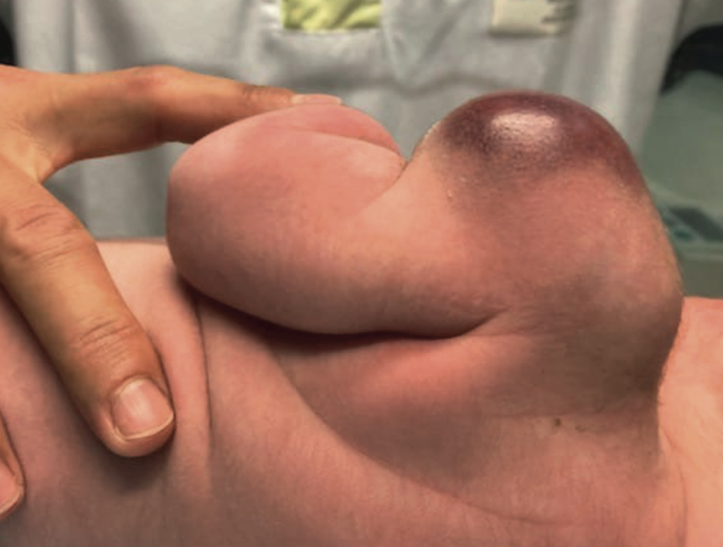 Syndrome lymphoprolifératif : quels sont les facteurs de pronostic ?