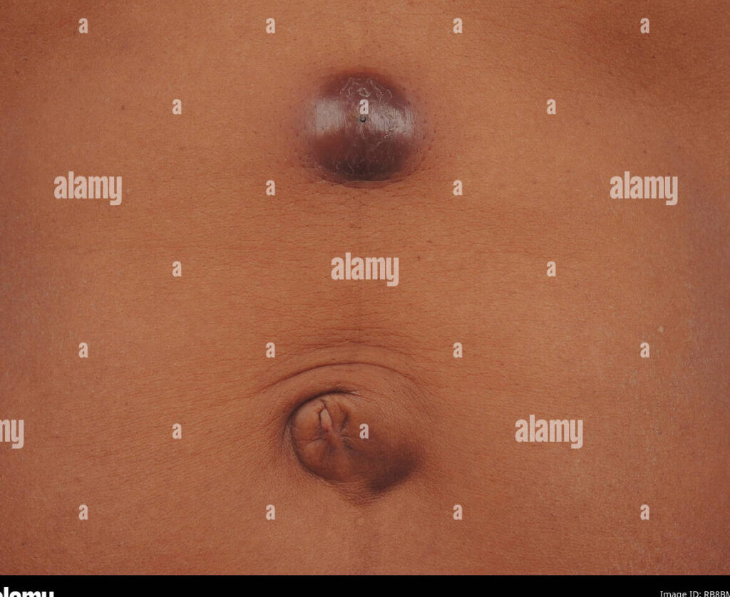 Quelles sont les caractéristiques d’un adénome sébacé ? Photos et explications
