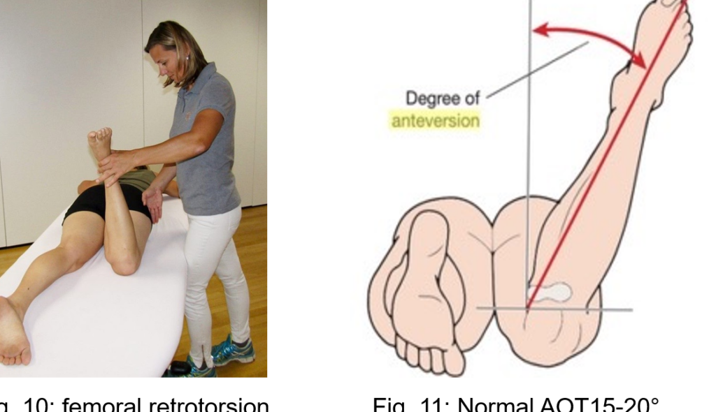 Antétorsion fémorale : comprendre cette condition pour mieux la gérer