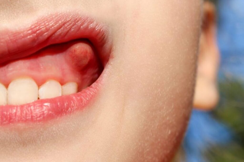Comment soigner un abcès périapical efficacement ?