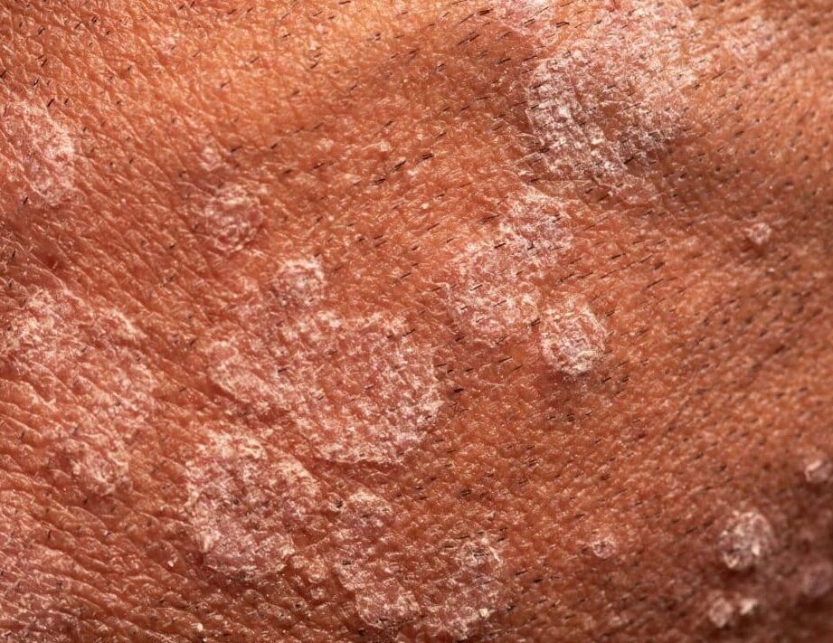 Comment traiter la folliculite de la barbe efficacement ?