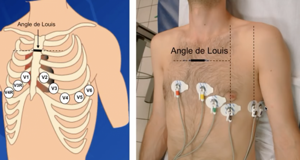 Flutter auriculaire et ECG : comment interpréter les signaux ?