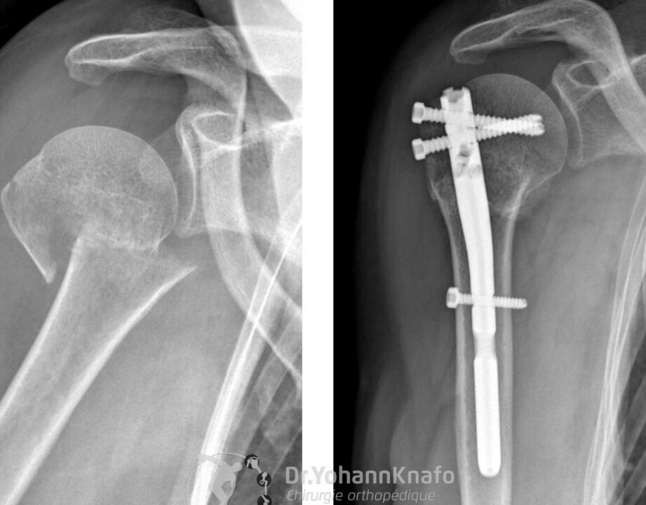 Fracture de l’épaule : symptômes, traitements et rééducation