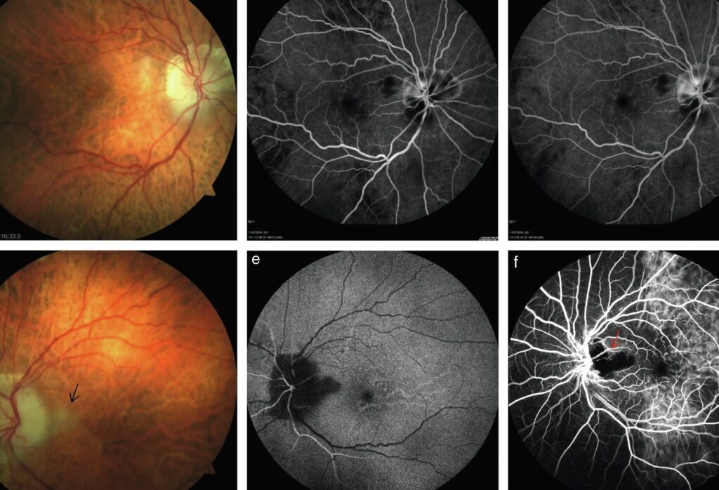 Quels sont les dangers des nodules de Lisch pour votre santé visuelle ?