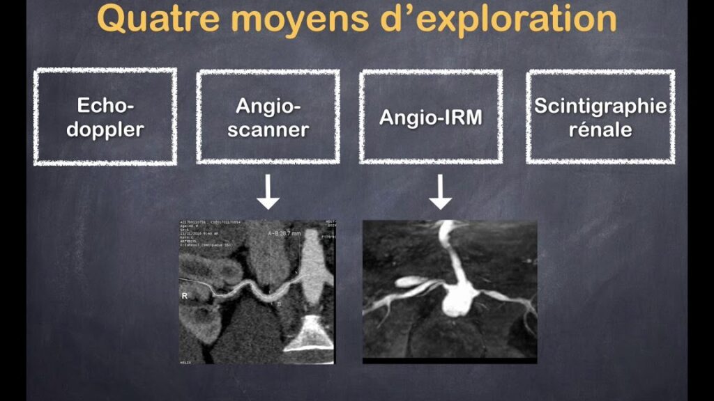 Quels sont les symptômes et traitements de la sténose de l’artère rénale ?