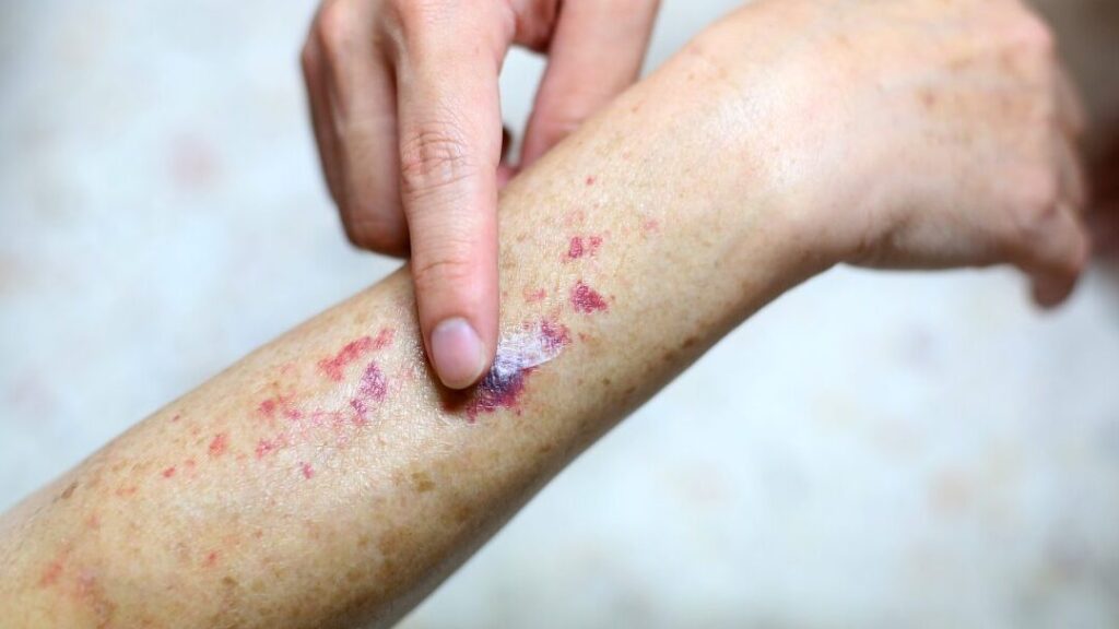 Thrombopathies : comment reconnaître et traiter ces troubles de la coagulation ?