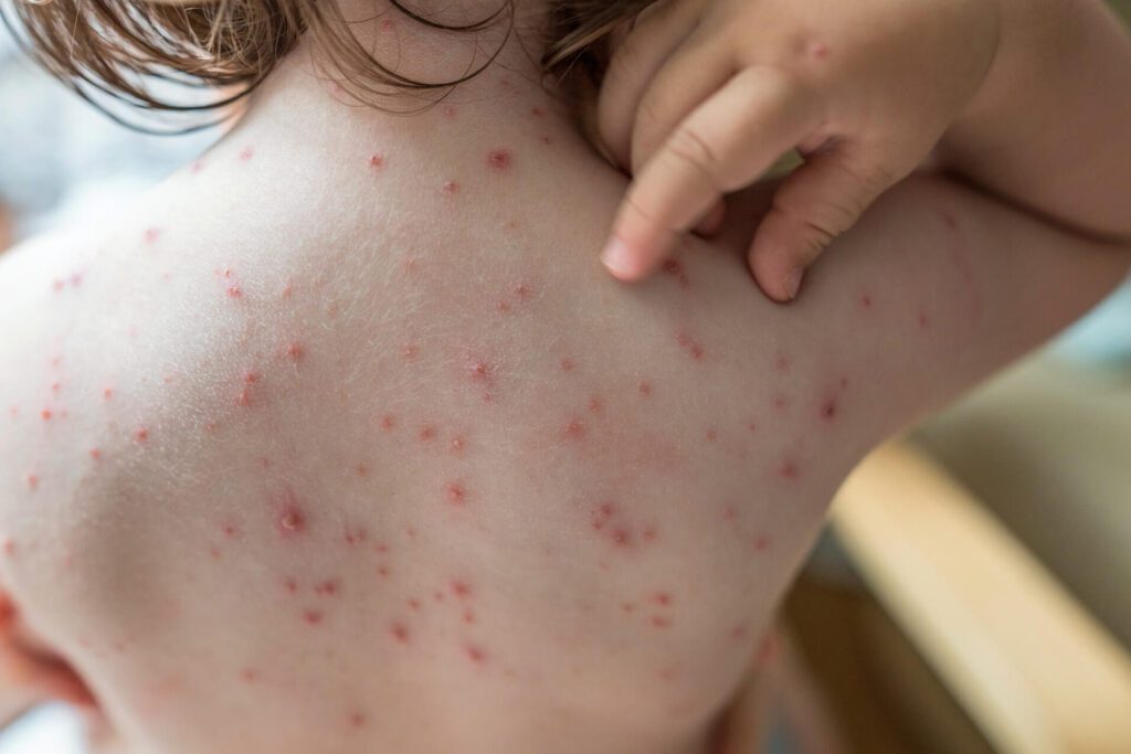 Comment identifier et traiter un bouton de varicelle infecté ? Photos et explications