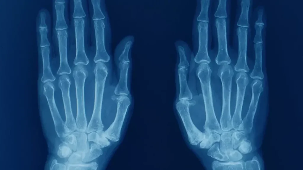 Comment identifier une fracture du métacarpe à partir d&rsquo;une photo ?