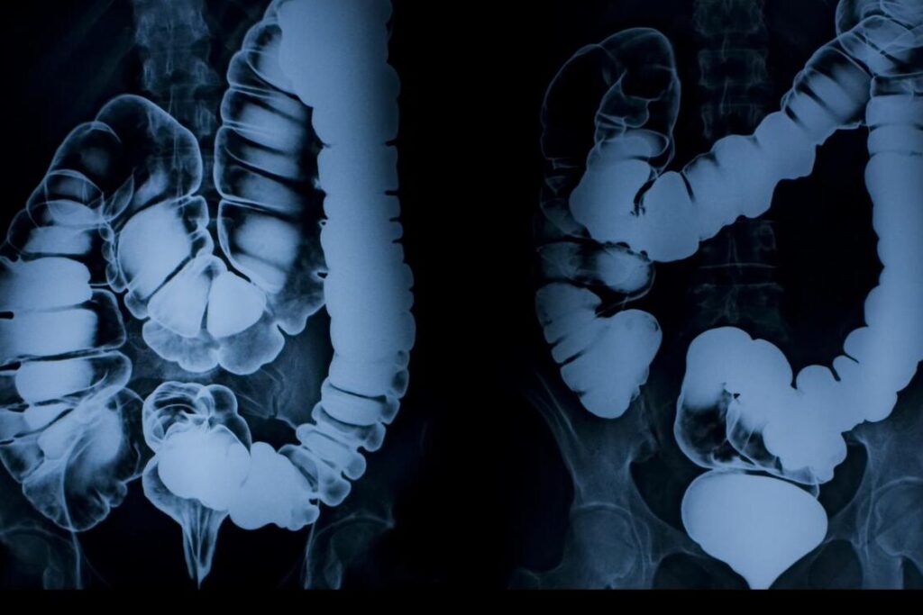 Comment la radio peut-elle aider à diagnostiquer la constipation ?