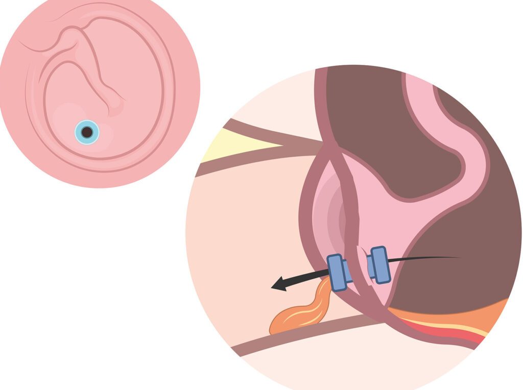 Myringotomie : quand et pourquoi est-elle nécessaire ?