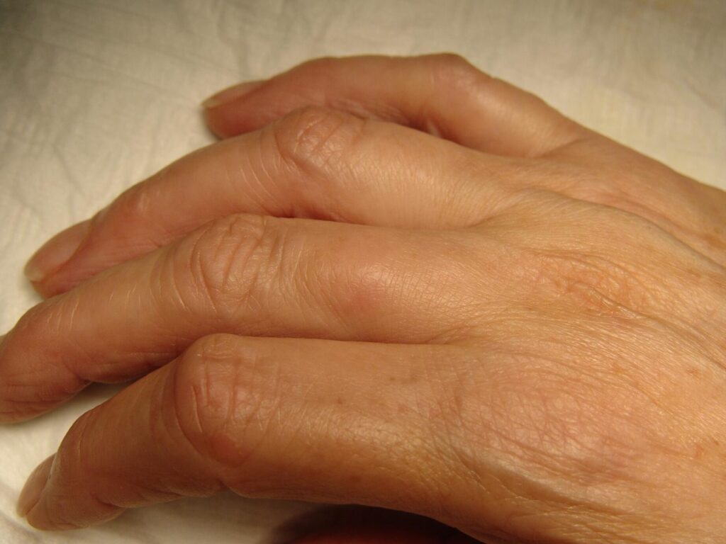 Photo cancer du doigt : comment reconnaître les signes ?
